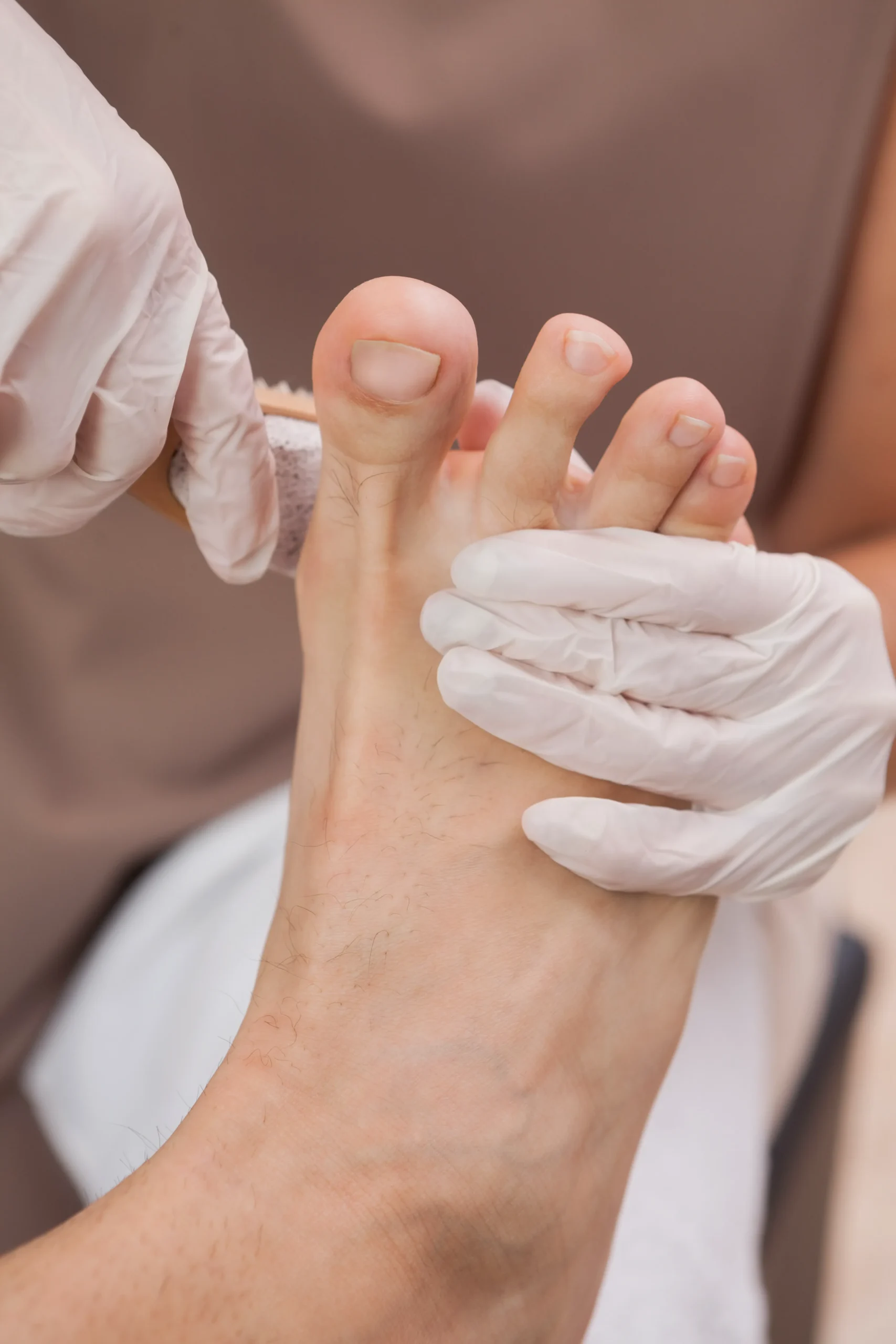 Onicogrifosis (uña en garra) en Málaga: qué es y cómo tratarla